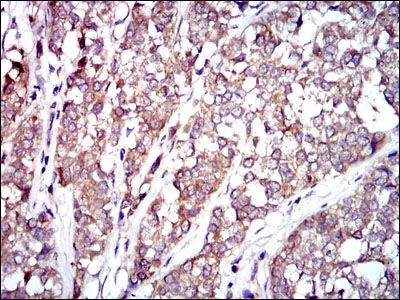 IHC-P analysis of bladder cancer tissue using GTX60561 Raf1 antibody [4G4].