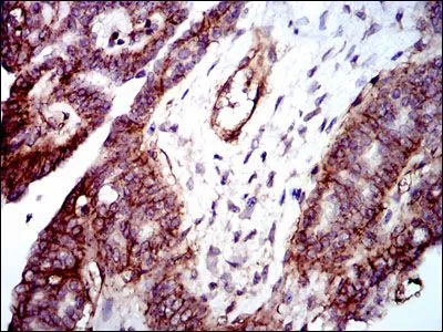 IHC-P analysis of ovarian cancer tissue using GTX60563 Integrin beta 1 / CD29 antibody [3B6].