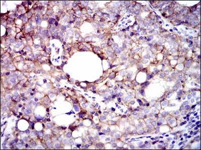 IHC-P analysis of cervical cancer tissue using GTX60563 Integrin beta 1 / CD29 antibody [3B6].