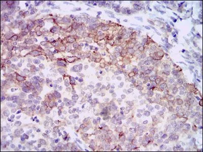 IHC-P analysis of cervical cancer tissue using GTX60588 HAS3 antibody [3C9].