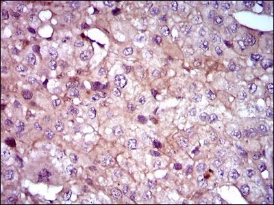IHC-P analysis of liver cancer tissue using GTX60606 Shh antibody [5H4].
