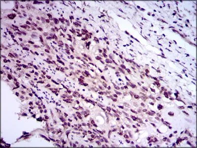 IHC-P analysis of esophageal cancer tissue using GTX60615 E2F1 antibody [8G9].