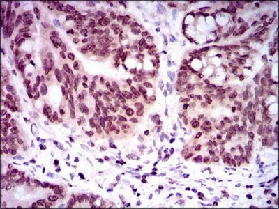 IHC-P analysis of rectum cancer tissue using GTX60623 GCNF antibody [4G8].