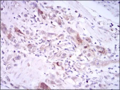 IHC-P analysis of stomach cancer tissue using GTX60627 PLK1 antibody [3C11].