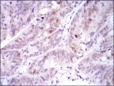 IHC-P analysis of rectum cancer tissue using GTX60627 PLK1 antibody [3C11].