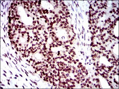 IHC-P analysis of ovarian cancer tissue using GTX60733 WHSC2 antibody [6B11H8].