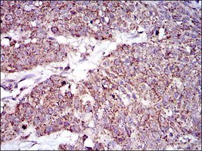 IHC-P analysis of esophageal cancer tissue using GTX60735 MRPL42 antibody [3H6G11].