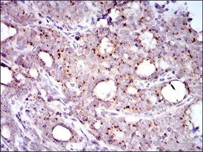 IHC-P analysis of cervical cancer tissue using GTX60735 MRPL42 antibody [3H6G11].