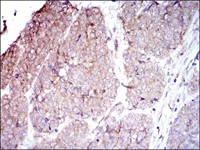 IHC-P analysis of esophageal cancer tissue using GTX60736 Integrin beta 4 antibody [10B10D5].
