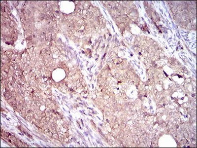IHC-P analysis of cervical cancer tissue using GTX60736 Integrin beta 4 antibody [10B10D5].