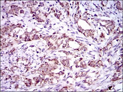 IHC-P analysis of cervical cancer tissue using GTX60742 DNAL4 antibody [3C10A4].