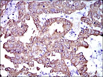 IHC-P analysis of endometrial cancer tissue using GTX60749 Cytokeratin 5 antibody [2C2B4].