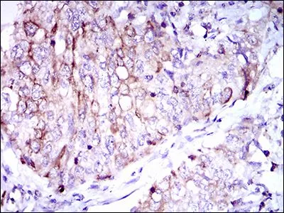 IHC-P analysis of lung cancer tissue using GTX60756 CD7 antibody [4D4F8].