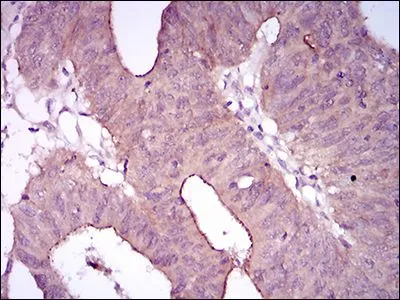 IHC-P analysis of rectum cancer tissues using GTX60763 CD41 antibody [2E10C9].