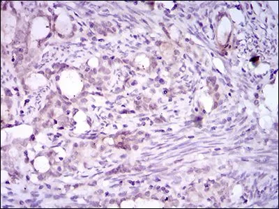 IHC-P analysis of cervical cancer tissues using GTX60763 CD41 antibody [2E10C9].