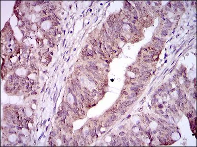 IHC-P analysis of rectum cancer tissue using GTX60764 CD41 antibody [2E10C9].