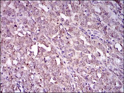 IHC-P analysis of cervical cancer tissue using GTX60764 CD41 antibody [2E10C9].
