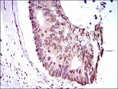IHC-P analysis of rectum cancer tissue using GTX60769 KLF1 antibody [1B6A3].