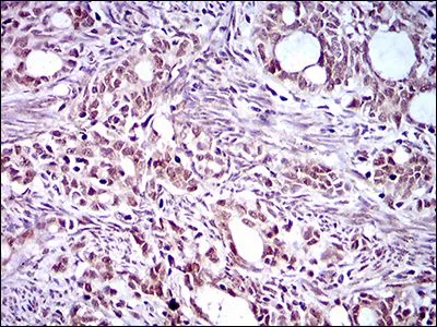 IHC-P analysis of cervical cancer tissue using GTX60769 KLF1 antibody [1B6A3].
