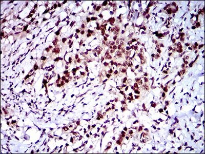 IHC-P analysis of cervical cancer tissue using GTX60781 FLIP antibody [7A3D12].