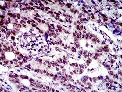 IHC-P analysis of esophageal cancer tissue using GTX60787 FLIP antibody [6G11A6].