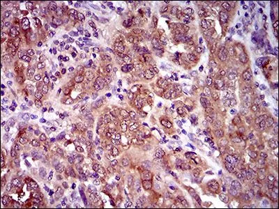IHC-P analysis of endometrial cancer tissue using GTX60793 CLGN antibody [1C8B6].