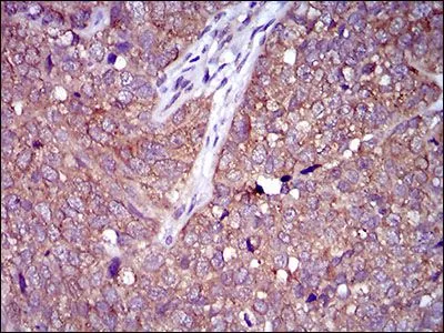 IHC-P analysis of bladder cancer tissue using GTX60793 CLGN antibody [1C8B6].