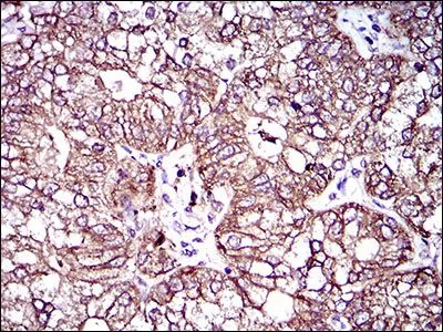 IHC-P analysis of esophagus cancer tissue using GTX60796 MRP4 antibody [6A7H3].