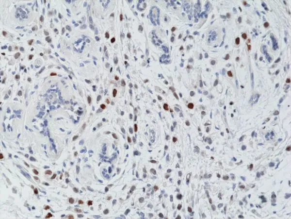 IHC-P analysis of human breast cancer tissue using GTX60897 Histone H3T3ph (phospho Thr3) antibody [RM159]. Dilution : 1microg/ml