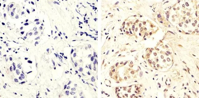 IHC-P analysis of human breast carcinoma tissue using GTX60929 PTEN (phospho Ser370) antibody. Right : Primary antibody Left : Negative control without primary antibody Antigen retrieval : 10mM sodium citrate (pH 6.0), microwaved for 8-15 min Dilution : 1:20 IHC-P analysis of human breast carcinoma tissue using GTX60929 PTEN (phospho Ser370) antibody. Right : Primary antibody Left : Negative control without primary antibody Antigen retrieval : 10mM sodium citrate (pH 6.0), microwaved for 8-15 min Dilution : 1:20