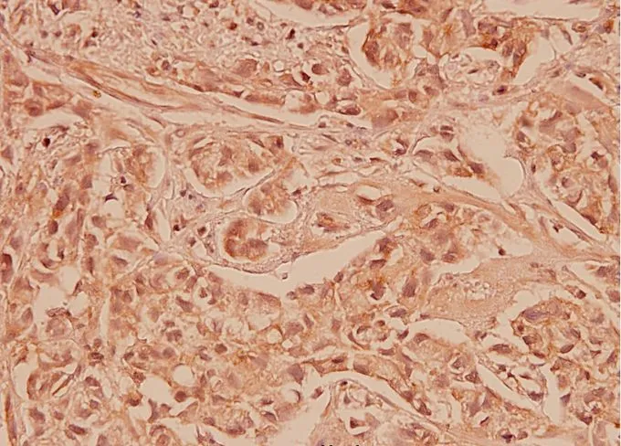 Immunohistochemistry (IHC) analyzes of Cox-2 pAb in paraffin-embedded human breast carcinoma tissue at 1:100.