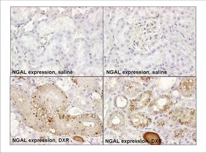 NGAL immunostaining in kidney, Formalin-fixed, paraffin-embedded tissue sections of cortical epithelial cells in the S1/S2 segments (proximal convoluted tubules) following DXR-induced acute kidney injury. Top panel, saline treatment; bottom panel, DXR treatment; X630 (1). NGAL immunostaining in kidney, Formalin-fixed, paraffin-embedded tissue sections of cortical epithelial cells in the S1/S2 segments (proximal convoluted tubules) following DXR-induced acute kidney injury. Top panel, saline treatment; bottom panel, DXR treatment; X630 (1).