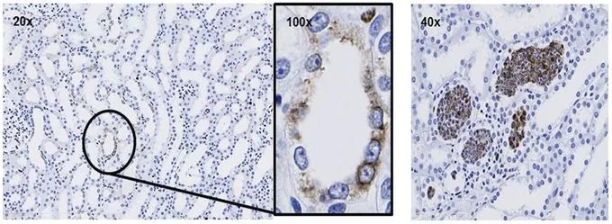 IHC staining for nephrotoxicant-induced NGAL protein expression in male Cynomolgus monkey using the BioPorto Diagnostics antibody (GTX60968) at 1:50. Mild multifocal staining was localized in apical surface of intact tubular epithelial cells in the cortex and medulla (left panel) and marked multifocal tubular cast (granular and cellular) in the cortex (right panel). Image: Kindly provided by McDuffie, J.E., J.Y. Ma et al (Janssen Research & Development, L.L.C.)