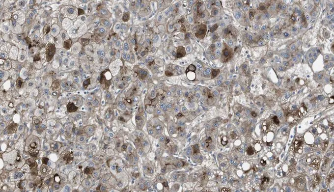 Paraffin-embedded human cancerous liver tissue immunostained with GTX60980 Paraffin-embedded human cancerous liver tissue immunostained with GTX60980