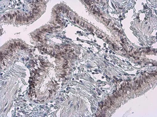 Cyclin B1 antibody [GT238] detects Cyclin B1 protein at cytoplasm and nucleus by immunohistochemical analysis. Sample: Paraffin-embedded human lung cancer. Cyclin B1 stained by Cyclin B1 antibody [GT238] (GTX628546) diluted at 1:200.
 Antigen Retrieval: Citrate buffer, pH 6.0, 15 min