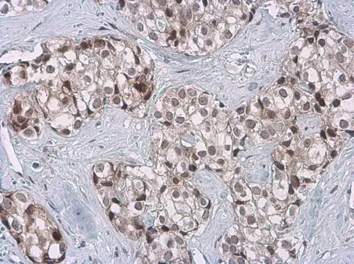 Cyclin B1 antibody [GT238] detects Cyclin B1 protein at cytoplasm and nucleus by immunohistochemical analysis. Sample: Paraffin-embedded human breast carcinoma. Cyclin B1 stained by Cyclin B1 antibody [GT238] (GTX628546) diluted at 1:200.
 Antigen Retrieval: Citrate buffer, pH 6.0, 15 min