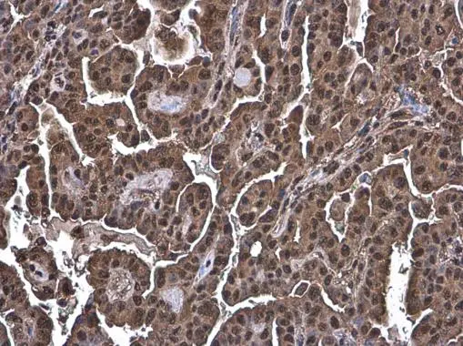 Ubiquitin antibody [GT751] detects Ubiquitin protein at cytoplasm and nucleus by immunohistochemical analysis. Sample: Paraffin-embedded human endometrial carcinoma. Ubiquitin stained by Ubiquitin antibody [GT751] (GTX630147) diluted at 1:200.
 Antigen Retrieval: Citrate buffer, pH 6.0, 15 min
