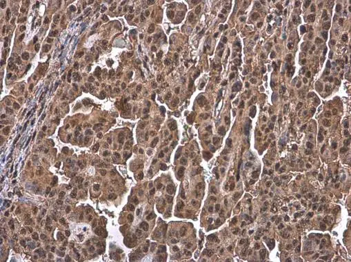 Ubiquitin antibody [GT7811] detects Ubiquitin protein at cytoplasm and nucleus by immunohistochemical analysis. Sample: Paraffin-embedded human endometrial carcinoma. Ubiquitin stained by Ubiquitin antibody [GT7811] (GTX630148) diluted at 1:200.
 Antigen Retrieval: Citrate buffer, pH 6.0, 15 min