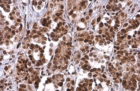 PRMT1 antibody [GT779] detects PRMT1 protein at cytoplasm and nucleus by immunohistochemical analysis. Sample: Paraffin-embedded human ovarian cancer. PRMT1 stained by PRMT1 antibody [GT779] (GTX630186) diluted at 1:200. Antigen Retrieval: Citrate buffer, pH 6.0, 15 min