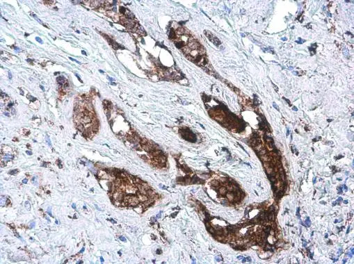 SOD2 antibody [GT1433] detects SOD2 protein at cytoplasm by immunohistochemical analysis. Sample: Paraffin-embedded human breast carcinoma. SOD2 stained by SOD2 antibody [GT1433] (GTX630559) diluted at 1:200.
 Antigen Retrieval: Citrate buffer, pH 6.0, 15 min