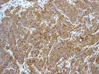 IHC-P analysis of human hepatocellular carcinoma using Caspase 8 antibody [EPR162] at a dilution of 1:100.
