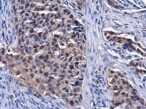 DCK antibody [GT10412] detects DCK protein at nucleus and cytoplasm in human lung cancer by immunohistochemical analysis. Sample: Paraffin-embedded human lung cancer. DCK antibody [GT10412] (GTX632065) diluted at 1:1000. 
 Antigen Retrieval: Citrate buffer, pH 6.0, 15 min