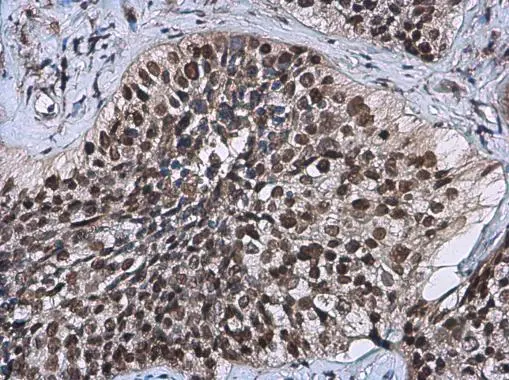 p63 antibody [GT1179] detects p63 protein at nucleus by immunohistochemical analysis. Sample: Paraffin-embedded human lung cancer. p63 stained by p63 antibody [GT1179] (GTX633818) diluted at 1:200.
 Antigen Retrieval: Citrate buffer, pH 6.0, 15 min