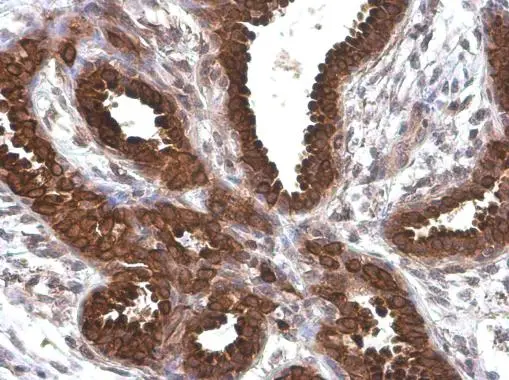 Anterior Gradient 2 antibody [GT5812] detects secreted Anterior Gradient 2 protein by immunohistochemical analysis. Sample: Paraffin-embedded human breast carcinoma. Anterior Gradient 2 stained by Anterior Gradient 2 antibody [GT5812] (GTX634163) diluted at 1:200.
 Antigen Retrieval: Citrate buffer, pH 6.0, 15 min