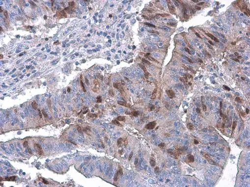 Cyclin A2 antibody [GT2547] detects Cyclin A2 protein at nucleus by immunohistochemical analysis. Sample: Paraffin-embedded human colon cancer. Cyclin A2 stained by Cyclin A2 antibody [GT2547] (GTX634420) diluted at 1:200.
 Antigen Retrieval: Citrate buffer, pH 6.0, 15 min