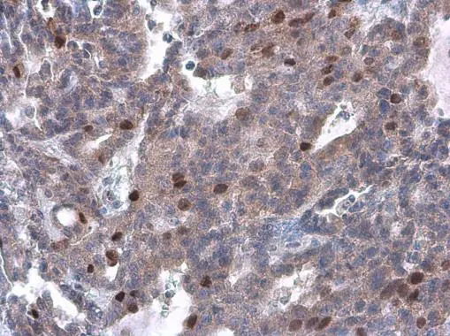Cyclin A2 antibody [GT2547] detects Cyclin A2 protein at nucleus by immunohistochemical analysis. Sample: Paraffin-embedded human endometrial carcinoma. Cyclin A2 stained by Cyclin A2 antibody [GT2547] (GTX634420) diluted at 1:200.
 Antigen Retrieval: Citrate buffer, pH 6.0, 15 min