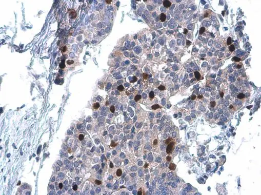 Cyclin A2 antibody [GT2547] detects Cyclin A2 protein at nucleus by immunohistochemical analysis. Sample: Paraffin-embedded human breast carcinoma. Cyclin A2 stained by Cyclin A2 antibody [GT2547] (GTX634420) diluted at 1:200.
 Antigen Retrieval: Citrate buffer, pH 6.0, 15 min
