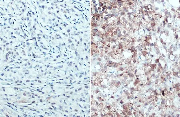 PD-L1 antibody [HL1041] detects PD-L1 protein at cell membrane by immunohistochemical analysis. Sample: Paraffin-embedded A549 (left) and MDA-MB-231 xenograft (right). PD-L1 stained by PD-L1 antibody [HL1041] (GTX635975) diluted at 1:1000. Antigen Retrieval: Citrate buffer, pH 6.0, 15 min