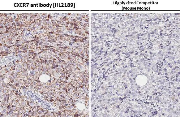 CXCR7 antibody [HL2189] detects CXCR7 protein at cell membrane by immunohistochemical analysis. Sample: Paraffin-embedded Raji xenograft. CXCR7 stained by CXCR7 antibody [HL2189] (GTX638193) diluted at 1:200 and competitor's antibody (MAB42273) diluted at 1:200. Antigen Retrieval: Citrate buffer, pH 6.0, 15 min *Competitor's antibody is not affiliated with GeneTex and does not endorse this product.
