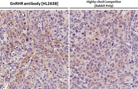 GnRHR antibody [HL2638] detects GnRHR protein at cell membrane by immunohistochemical analysis. Sample: Paraffin-embedded PC-3 xenograft. GnRHR stained by GnRHR antibody [HL2638] (GTX639094) diluted at 1:200 and competitor's antibody (19950-1-AP) diluted at 1:200. Antigen Retrieval: Citrate buffer, pH 6.0, 15 min *Competitor's antibody is not affiliated with GeneTex and does not endorse this product.